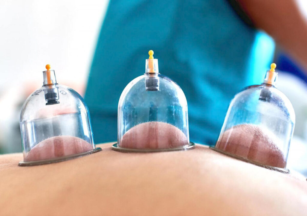 Hijama cupping behandeling