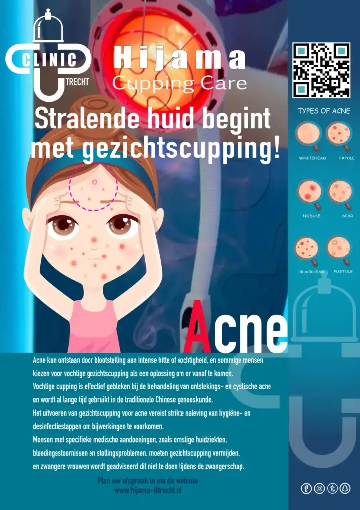 Hijama behandeling voor acne