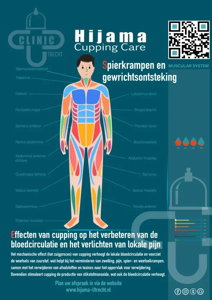 Hijama bij spierkrampen