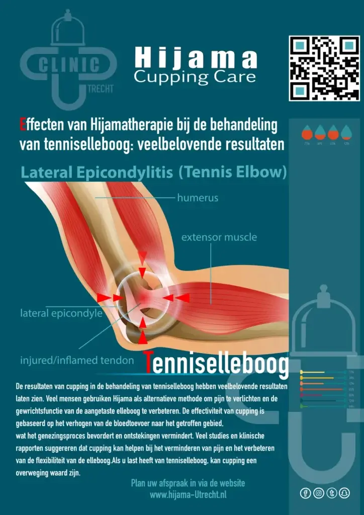 Hijama bij tenniselleboog